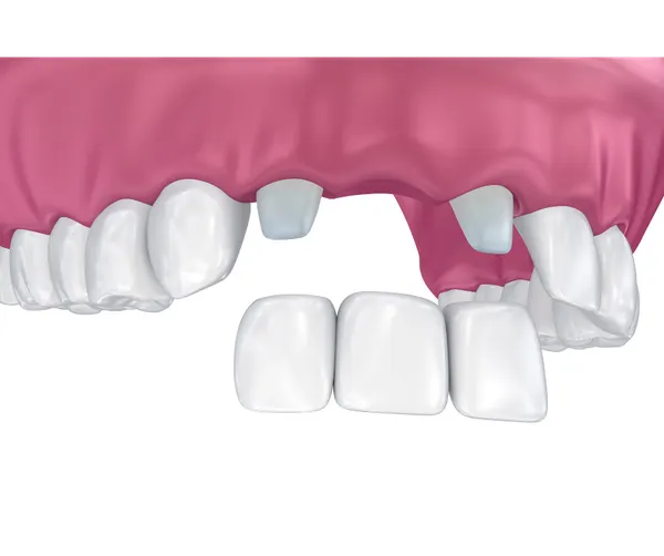 Dental Implants vs. Bridges: A Practical Comparison
