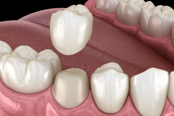 Custom porcelain crowns and bridges for natural restorations