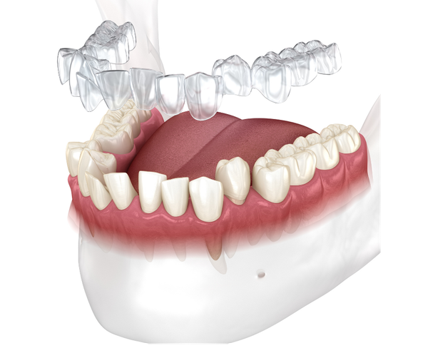 Invisalign clear aligners for adult orthodontics
