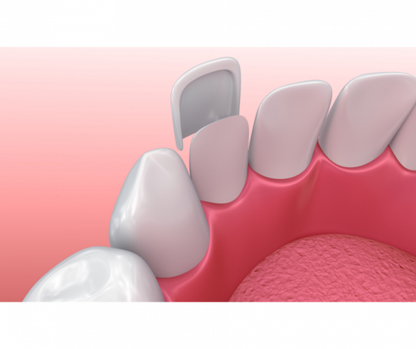 Hand-layered porcelain veneers for cosmetic smile design