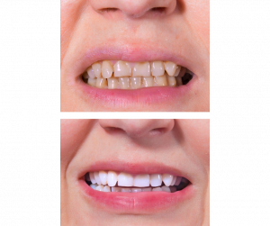 Professional KöR teeth whitening for a luminous smile